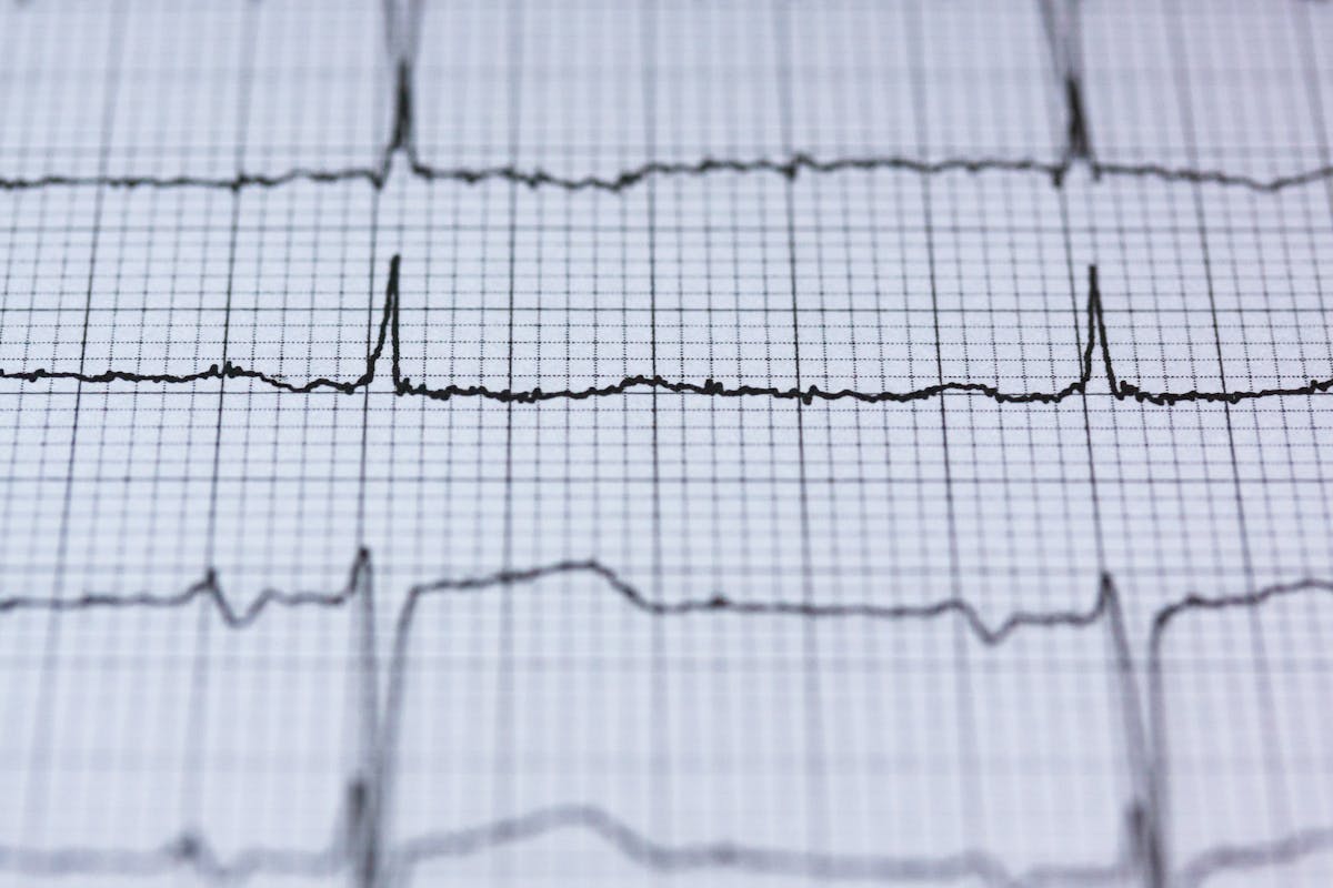 1. Care sunt elementele care definesc aritmia cardiaca_inregistrare EKG