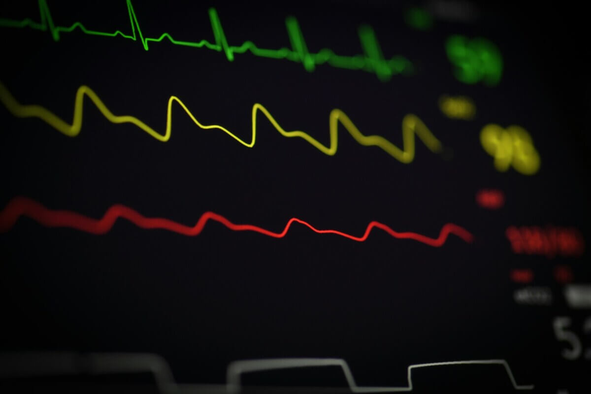 2. Ce este EKG. Ce înseamnă EKG - cum se face electrocardiograma și cum se interpretează rezultatele (1)