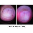 Dermatoscop DermLite Foto X + Nailio