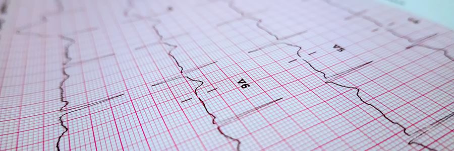 Ce este electrocardiograma și ce boli pot fi depistate cu ajutorul acesteia?
