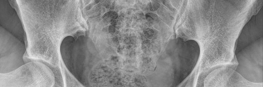 Salpingografia – metoda imagistică inovatoare de investigare a trompelor uterine