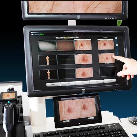Dermatoscop MoleMax HD PRO